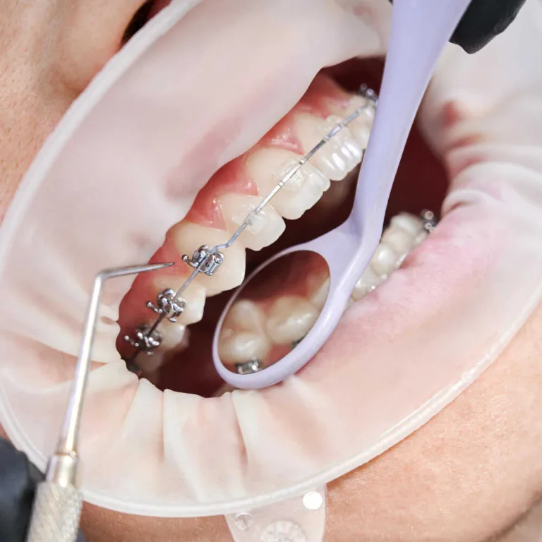 Jak zdiagnozować zęby do leczenia ortodontycznego?